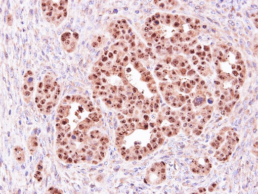 IHC of paraffin-embedded NCI-N87 xenograft using ALOXE3 antibody at 1:500 dilution.