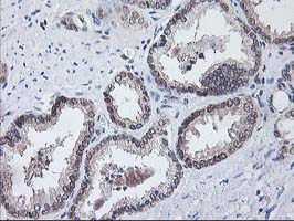 IHC of paraffin-embedded Carcinoma of Human prostate tissue using anti-NIF3L1 mouse monoclonal antibody.