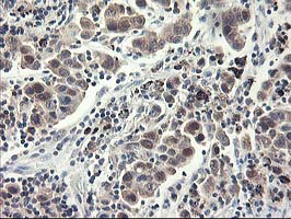 IHC of paraffin-embedded Carcinoma of Human lung tissue using anti-NIF3L1 mouse monoclonal antibody.