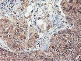 IHC of paraffin-embedded Carcinoma of Human bladder tissue using anti-NIF3L1 mouse monoclonal antibody.