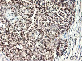 IHC of paraffin-embedded Adenocarcinoma of Human ovary tissue using anti-NIF3L1 mouse monoclonal antibody.