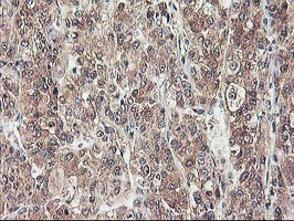 IHC of paraffin-embedded Carcinoma of Human liver tissue using anti-NIF3L1 mouse monoclonal antibody.