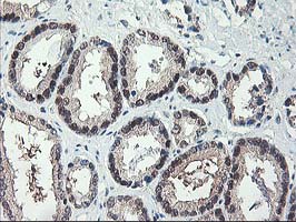 IHC of paraffin-embedded Carcinoma of Human prostate tissue using anti-NIF3L1 mouse monoclonal antibody.