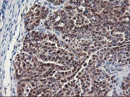 IHC of paraffin-embedded Adenocarcinoma of Human ovary tissue using anti-NIF3L1 mouse monoclonal antibody.