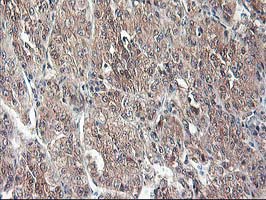 IHC of paraffin-embedded Carcinoma of Human liver tissue using anti-NIF3L1 mouse monoclonal antibody.