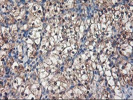 IHC of paraffin-embedded Carcinoma of Human kidney tissue using anti-NIF3L1 mouse monoclonal antibody.