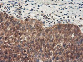 IHC of paraffin-embedded Carcinoma of Human bladder tissue using anti-NIF3L1 mouse monoclonal antibody.