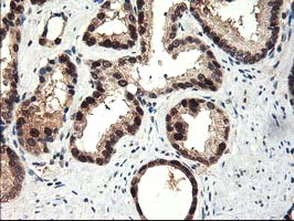 IHC of paraffin-embedded Carcinoma of Human prostate tissue using anti-NIF3L1 mouse monoclonal antibody.