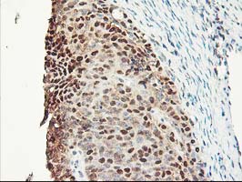 IHC of paraffin-embedded Adenocarcinoma of Human ovary tissue using anti-NIF3L1 mouse monoclonal antibody.