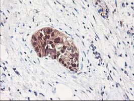 IHC of paraffin-embedded Adenocarcinoma of Human breast tissue using anti-NIF3L1 mouse monoclonal antibody.