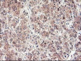 IHC of paraffin-embedded Carcinoma of Human liver tissue using anti-NIF3L1 mouse monoclonal antibody.