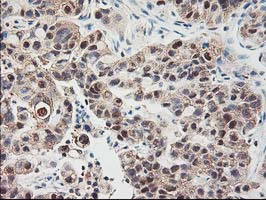 IHC of paraffin-embedded Carcinoma of Human lung tissue using anti-NIF3L1 mouse monoclonal antibody.