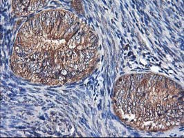 IHC of paraffin-embedded Adenocarcinoma of Human endometrium tissue using anti-NIF3L1 mouse monoclonal antibody.