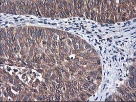 IHC of paraffin-embedded Carcinoma of Human bladder tissue using anti-NIF3L1 mouse monoclonal antibody.