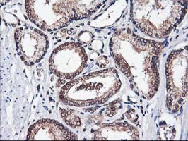 IHC of paraffin-embedded Carcinoma of Human prostate tissue using anti-NIF3L1 mouse monoclonal antibody.