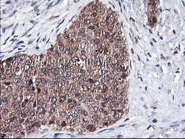 IHC of paraffin-embedded Adenocarcinoma of Human breast tissue using anti-NIF3L1 mouse monoclonal antibody.