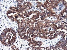 IHC of paraffin-embedded Adenocarcinoma of Human ovary tissue using anti-NIF3L1 mouse monoclonal antibody.