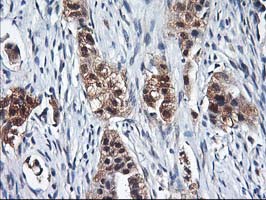 IHC of paraffin-embedded Carcinoma of Human lung tissue using anti-NIF3L1 mouse monoclonal antibody.