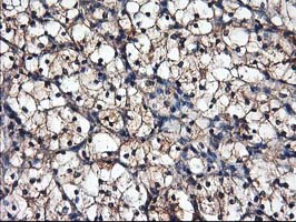 IHC of paraffin-embedded Carcinoma of Human kidney tissue using anti-NIF3L1 mouse monoclonal antibody.
