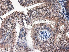 IHC of paraffin-embedded Adenocarcinoma of Human endometrium tissue using anti-NIF3L1 mouse monoclonal antibody. (Heat-induced epitope retrieval by 10mM citric buffer, pH6.0, 100C for 10min).