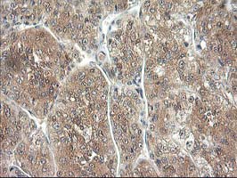IHC of paraffin-embedded Carcinoma of Human liver tissue using anti-NIF3L1 mouse monoclonal antibody. (Heat-induced epitope retrieval by 10mM citric buffer, pH6.0, 100C for 10min).