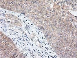 IHC of paraffin-embedded Carcinoma of Human bladder tissue using anti-NIF3L1 mouse monoclonal antibody. (Heat-induced epitope retrieval by 10mM citric buffer, pH6.0, 100C for 10min).