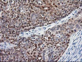 IHC of paraffin-embedded Adenocarcinoma of Human ovary tissue using anti-NIF3L1 mouse monoclonal antibody. (Heat-induced epitope retrieval by 10mM citric buffer, pH6.0, 100C for 10min).