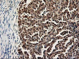 IHC of paraffin-embedded Adenocarcinoma of Human ovary tissue using anti-NIF3L1 mouse monoclonal antibody.