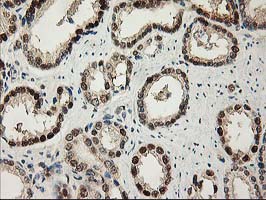 IHC of paraffin-embedded Carcinoma of Human prostate tissue using anti-NIF3L1 mouse monoclonal antibody.