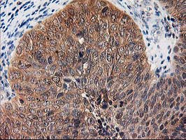 IHC of paraffin-embedded Carcinoma of Human bladder tissue using anti-NIF3L1 mouse monoclonal antibody.