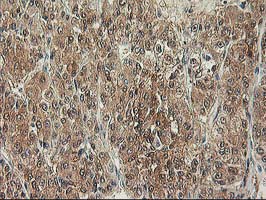 IHC of paraffin-embedded Carcinoma of Human liver tissue using anti-NIF3L1 mouse monoclonal antibody.