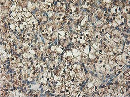 IHC of paraffin-embedded Carcinoma of Human kidney tissue using anti-NIF3L1 mouse monoclonal antibody.