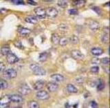 Formalin-fixed and paraffin-embedded human breast carcinoma tissue reacted with AMBRA1 antibody , which was peroxidase-conjugated to the secondary antibody, followed by DAB staining. This data demonstrates the use of this antibody for immunohistochemistry; clinical relevance has not been evaluated.