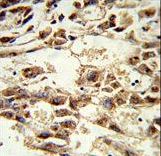 Formalin-fixed and paraffin-embedded human hepatocarcinoma reacted with AIFM2 Antibody , which was peroxidase-conjugated to the secondary antibody, followed by DAB staining. This data demonstrates the use of this antibody for immunohistochemistry; clinical relevance has not been evaluated.