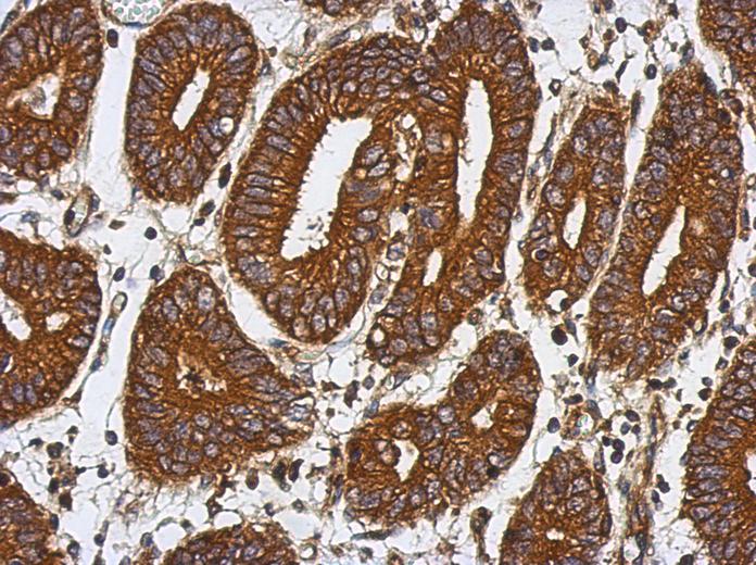 IHC of paraffin-embedded Colon ca, using BAT5 antibody at 1:500 dilution.