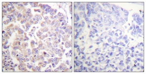 IHC of paraffin-embedded human breast carcinoma, using APC1 (Phospho-Ser688) Antibody. The sample on the right was incubated with synthetic peptide.