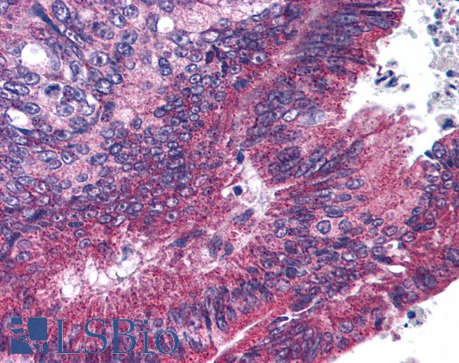 Anti-ANAPC1 antibody IHC of human pancreatic carcinoma. Immunohistochemistry of formalin-fixed, paraffin-embedded tissue after heat-induced antigen retrieval. Antibody LS-B68 concentration 10 ug/ml.