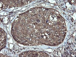 IHC of paraffin-embedded Carcinoma of Human lung tissue using anti-ANAPC11 mouse monoclonal antibody.