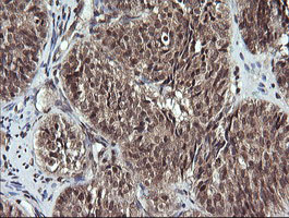 IHC of paraffin-embedded Adenocarcinoma of Human ovary tissue using anti-ANAPC11 mouse monoclonal antibody. (Heat-induced epitope retrieval by 10mM citric buffer, pH6.0, 120°C for 3min).