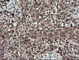 IHC of paraffin-embedded Carcinoma of Human lung tissue using anti-ANAPC11 mouse monoclonal antibody. (Heat-induced epitope retrieval by 10mM citric buffer, pH6.0, 120°C for 3min).