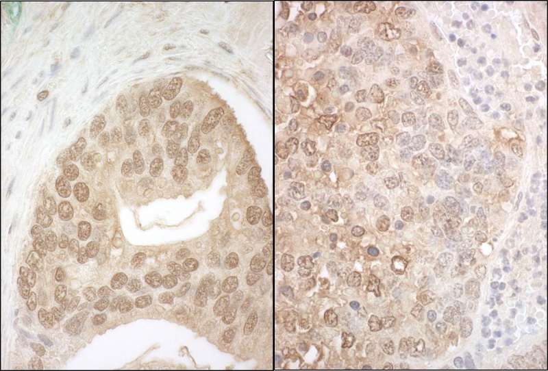 Detection of Human and Mouse APC7 by Immunohistochemistry. Sample: FFPE section of human prostate carcinoma (left) and mouse teratoma (right). Antibody: Affinity purified rabbit anti-APC7 used at a dilution of 1:200 (1 ug/ml).