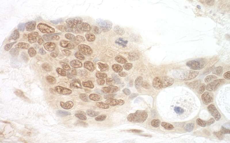 Detection of Human APC7 by Immunohistochemistry. Sample: FFPE section of human ovarian carcinoma. Antibody: Affinity purified rabbit anti-APC7 used at a dilution of 1:250.