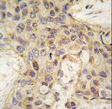 Formalin-fixed and paraffin-embedded human breast carcinoma tissue reacted with ANGEL2 antibody , which was peroxidase-conjugated to the secondary antibody, followed by DAB staining. This data demonstrates the use of this antibody for immunohistochemistry; clinical relevance has not been evaluated.