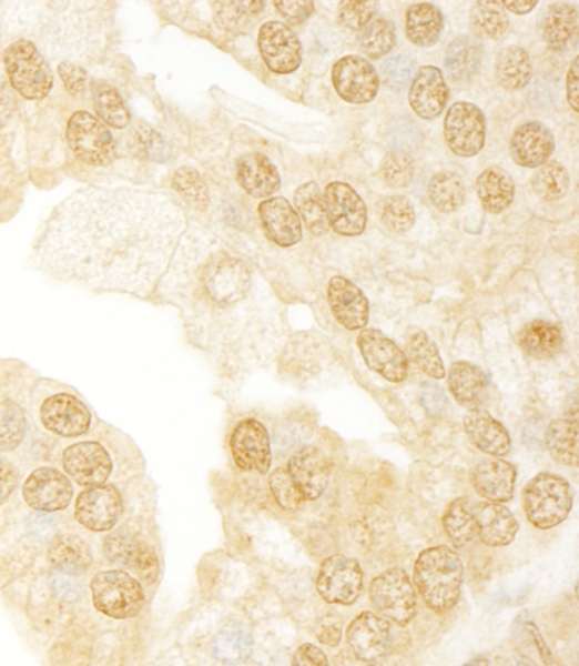 Detection of Human ANKRD17 by Immunohistochemistry. Sample: FFPE section of human prostate carcinoma. Antibody: Affinity purified rabbit anti-ANKRD17 used at a dilution of 1:1000 (1 ug/ml).
