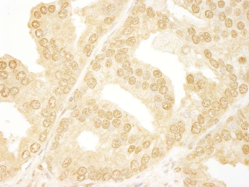 Detection of Human ANKRD17 by Immunohistochemistry. Sample: FFPE section of human prostate carcinoma. Antibody: Affinity purified rabbit anti-ANKRD17 used at a dilution of 1:250.