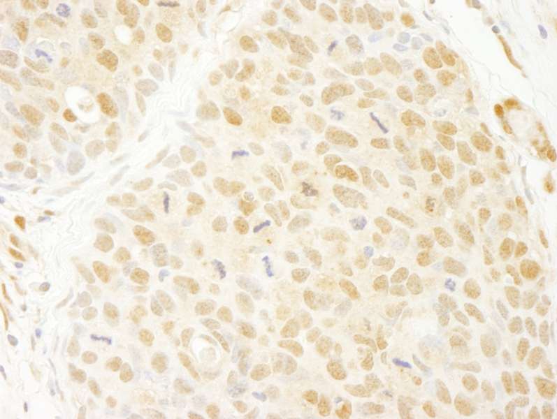 Detection of Human ANKRD17 by Immunohistochemistry. Sample: FFPE section of human breast carcinoma. Antibody: Affinity purified rabbit anti-ANKRD17 used at a dilution of 1:250.