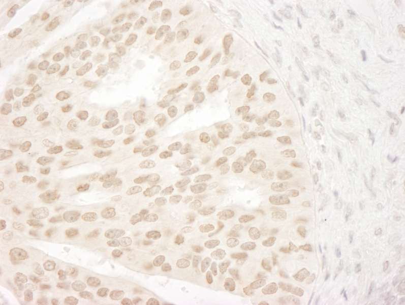 Detection of Human ANKRD28/PITK by Immunohistochemistry. Sample: FFPE section of human prostate carcinoma. Antibody: Affinity purified rabbit anti-ANKRD28/PITK used at a dilution of 1:1000 (0.2 ug/ml).