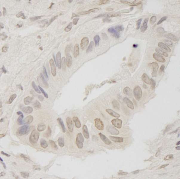 Detection of Human ANKRD28/PITK Immunohistochemistry. Sample: FFPE section of human stomach carcinoma. Antibody: Affinity purified rabbit anti-ANKRD28/PITK used at a dilution of 1:250. Epitope Retrieval Buffer-High pH (IHC-101J) was substituted for Epitope Retrieval Buffer-Reduced pH.