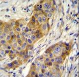ANR39 Antibody immunohistochemistry of formalin-fixed and paraffin-embedded human breast carcinoma followed by peroxidase-conjugated secondary antibody and DAB staining.