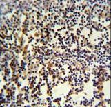 ANR49 Antibody IHC of formalin-fixed and paraffin-embedded human lymph carcinoma followed by peroxidase-conjugated secondary antibody and DAB staining.